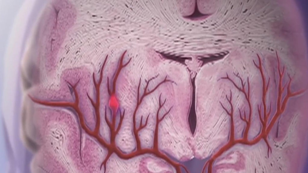 Knowing the signs of a stroke can save lives — Vinings Community news